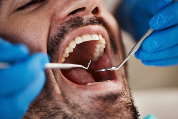 Best Emergency Dental Care for Broken or Chipped Teeth in Harrisburg, SD